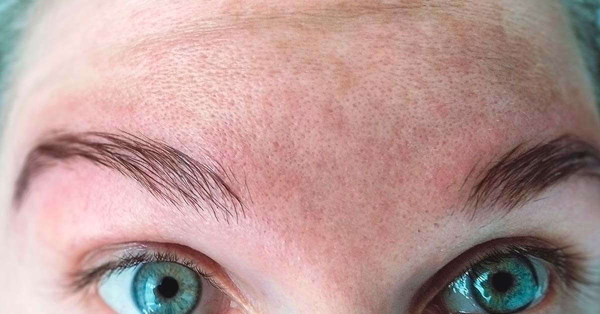 Pronóstico del Melasma